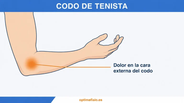 Ilustración de un brazo con la zona habitual de dolor del codo de tenista señalada en la cara externa del codo.