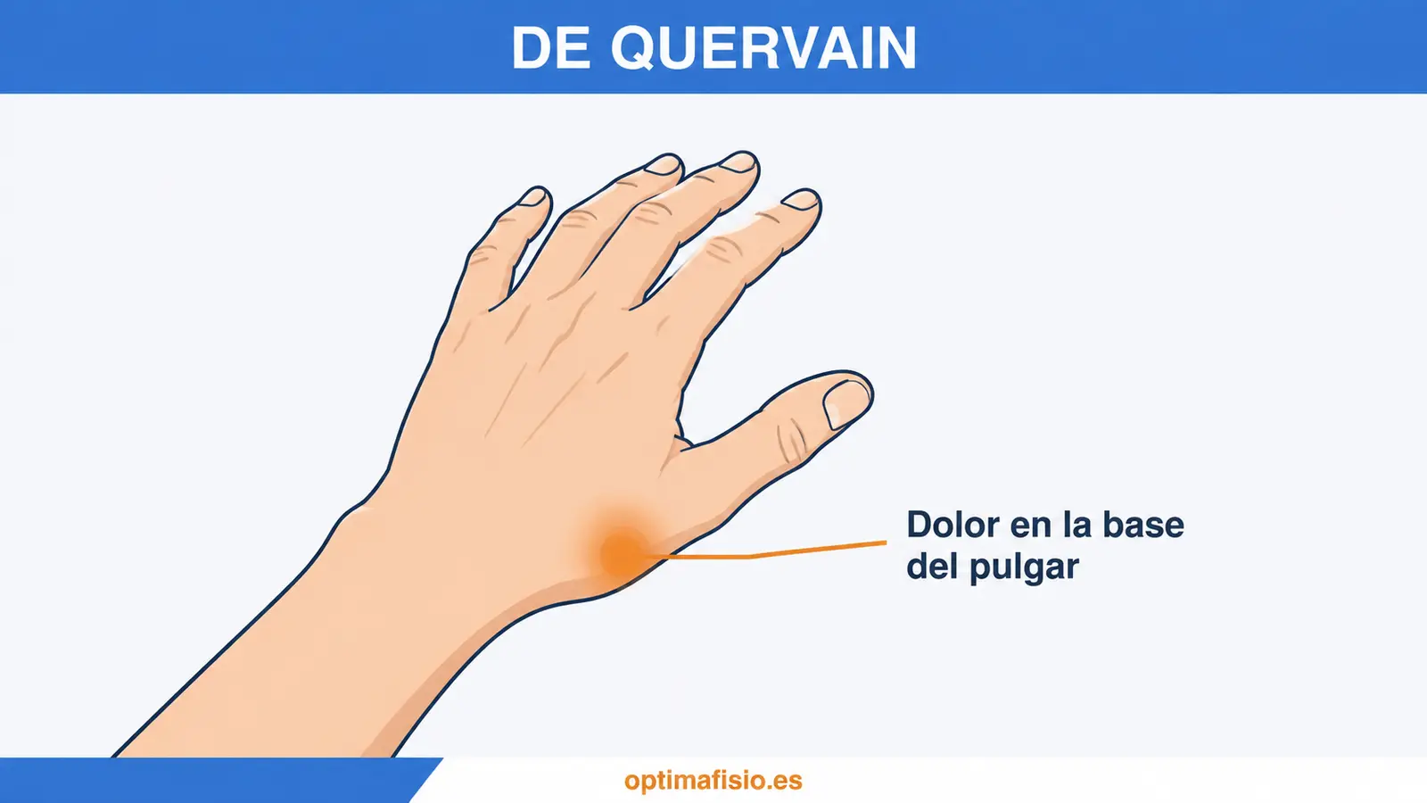 Ilustración de una mano con la zona de dolor de la tenosinovitis de De Quervain señalada en la base del pulgar.