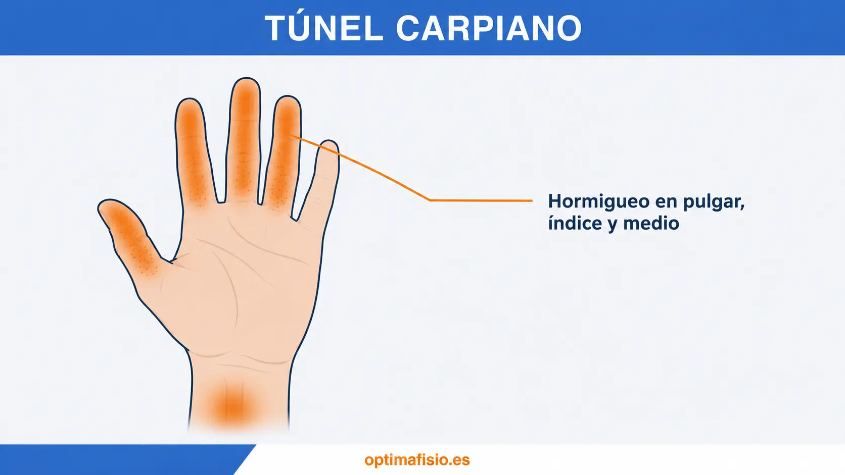 Ilustración de una mano con las zonas habituales de hormigueo en el síndrome del túnel carpiano